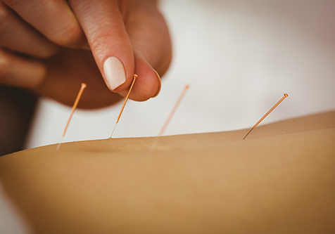 acupuncture-treatment
